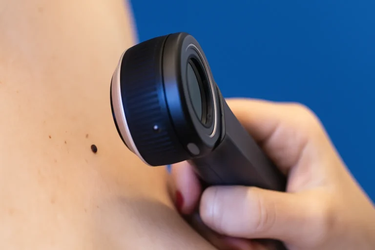 dermatoscopia