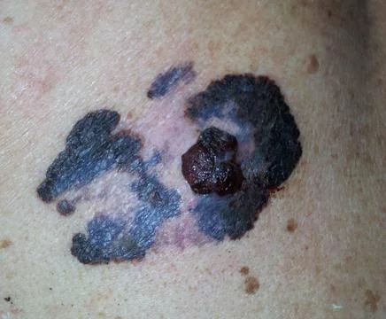Prevenção é vida: não ignore “pintinhas” na pele