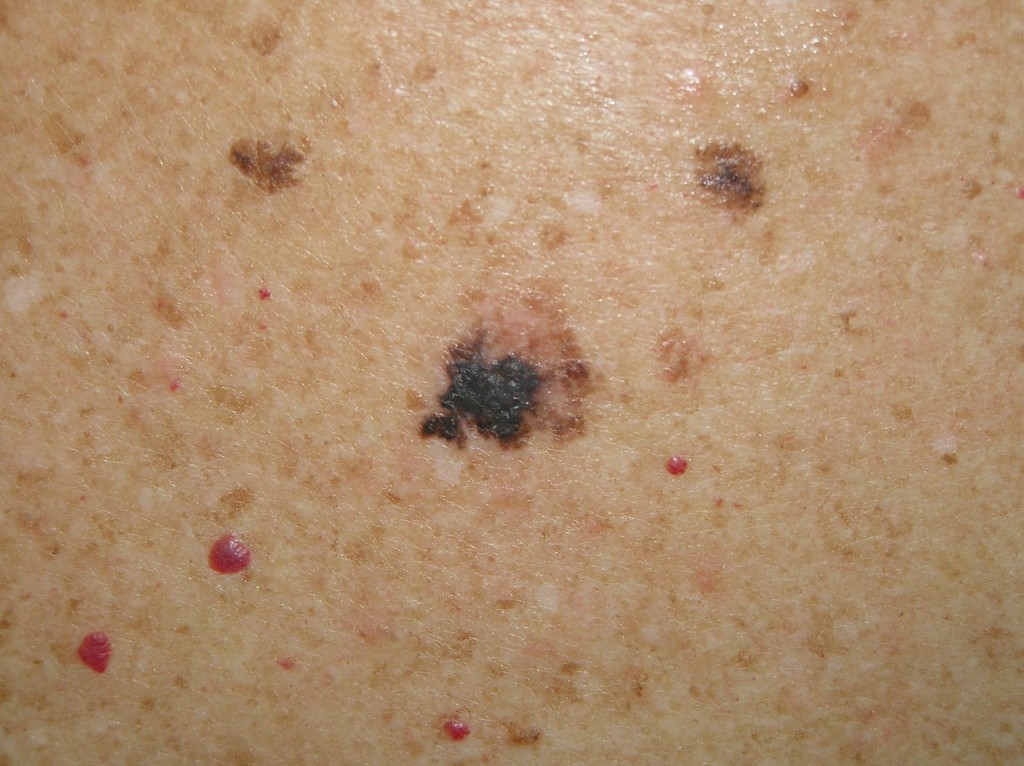 Melanoma: o que é, quais os sinais e quando se torna uma emergência médica